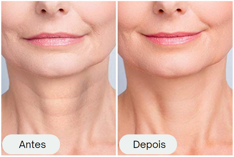 Botox Adesivo